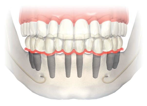 Illustration of several dental implant posts and crowns, surgically added to lower jaw